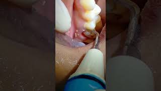 إزالة جير الأسنان || removal dental calculus dr_abdullah_sultan_dentist dentist 소아치과 orthodontic