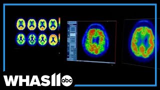 Dementia cases expected to double by 2060, new study suggests many are preventable