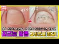 찌르는발톱 교정! 많이 안휘어져보인다고요?? 발톱의 속사정 해결해드려요 ingrowing nail - 레푸스 남양주호평점 Refuss