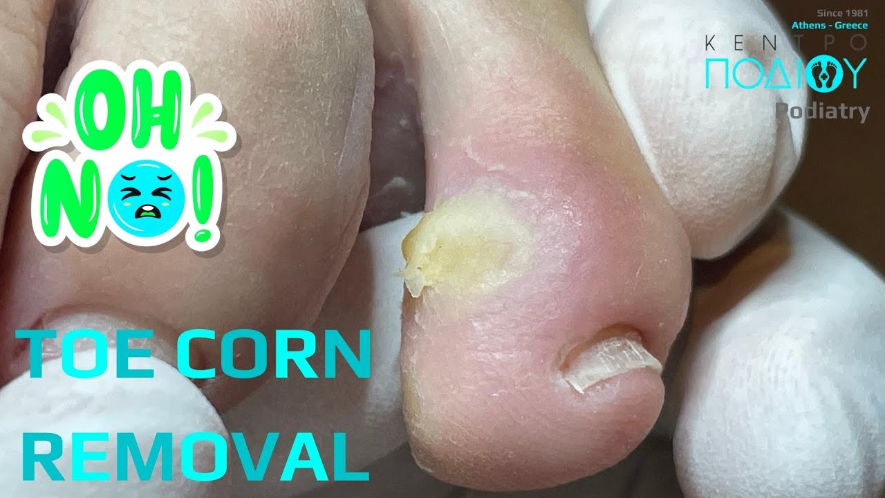 SOFT CORN ENUCLEATIONΑφαίρεση μεσοδακτύλιου κάλουΚέντρο Ποδιού