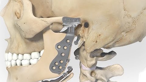 Total-joint Replacement