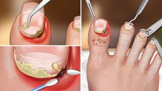 ASMR  Remove ingrown toenails, toenail clipping, toenail swelling and clean up pedicure screenshot 1