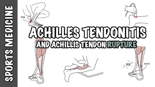 Achilles Tendonitis and Tendon Rupture - Overview