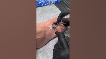 Quá trình Xóa Xăm Không Sẹo bằng công nghệ Pico Laser ⚡️Tattoo Removal Da Nang Vietnam