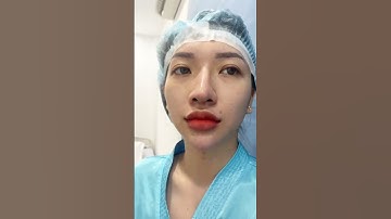 Tháo sụn mũi bị viêm #shorts