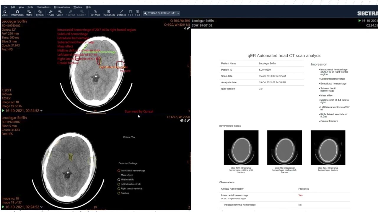 How to qER Radiology AI in Sectra PACS - YouTube