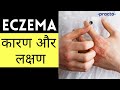 Eczema (एक्जिमा): Causes, Symptoms & Types | Atopic & Seborrheic Dermatitis Symptoms (Hindi)| Practo