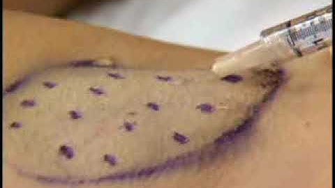 Botox for AXILLARY Hyperhidrosis (#armpits) Dr Dee Anna Glaser, International Hyperhidrosis Society©