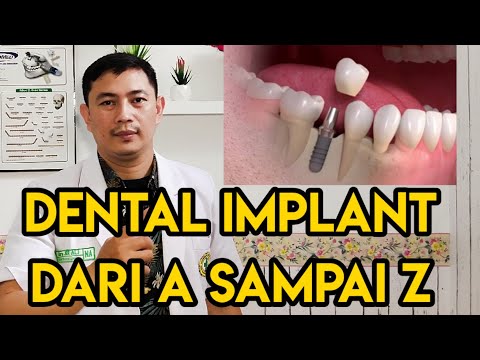 Video: Masalah Implan Gigi Awal Dan Akhir