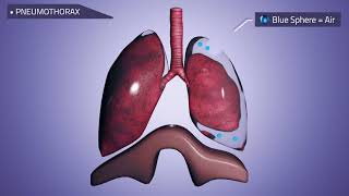 Physiodrain® chest drainage  x water seal