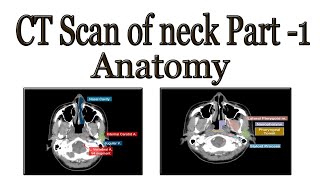 CT Scan of neck anatomy part 1 screenshot 3