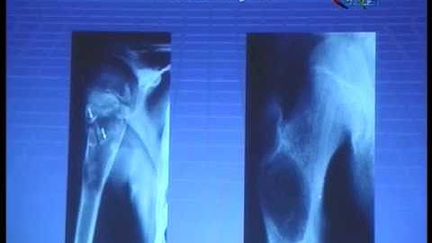 Lecture 09 b conventional radiology bone tumor 2 dr mohamed abdelfatah