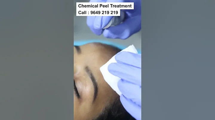 Best Chemical Peel Treatment at Skinaa Clinic | Viral #shorts