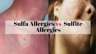 glutathione and sulfa allergy Card in English (Printable) Sulfa allergy