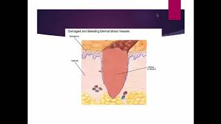 Wound Identification and Documentation in Home Care