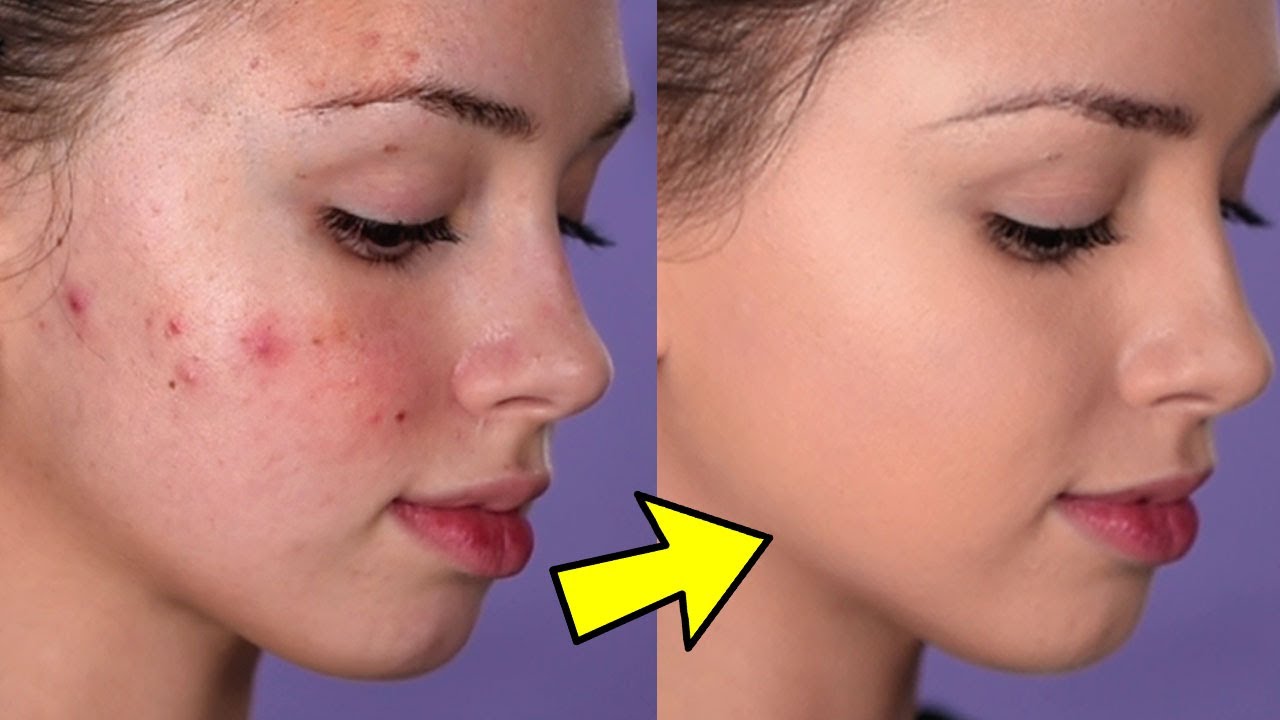 How To Cover Acne and ( EASY & NON-CAKEY ) - YouTube