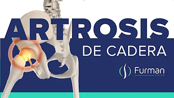 ¿Cómo tratar la artritis de cadera de forma natural?