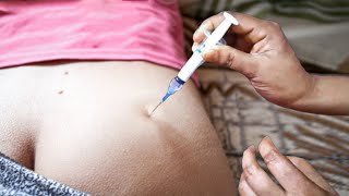 Im Intramuscular Injection Ventrogluteal Ceftriaxone 500Mg Dexamethasone Clinical Technique