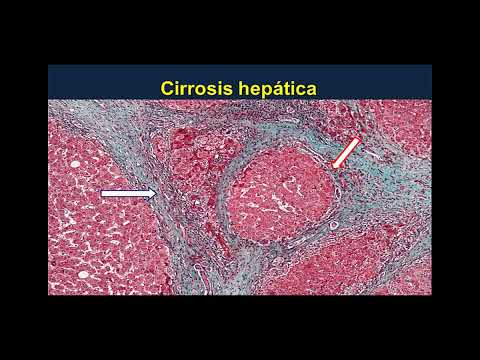 Fisiopatologia de la Cirrosis e Hipertension Portal