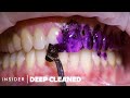 How teeth are professionally deep cleaned  deep cleaned