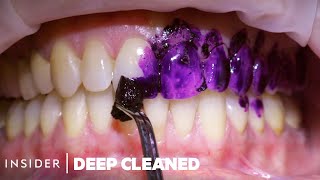 How Teeth Are Professionally Deep Cleaned | Deep Cleaned Resimi