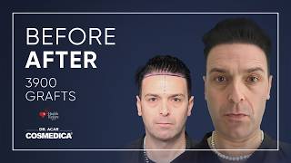 Hair Transplant In Turkey Results Dr. Acar Cosmedica Clinic