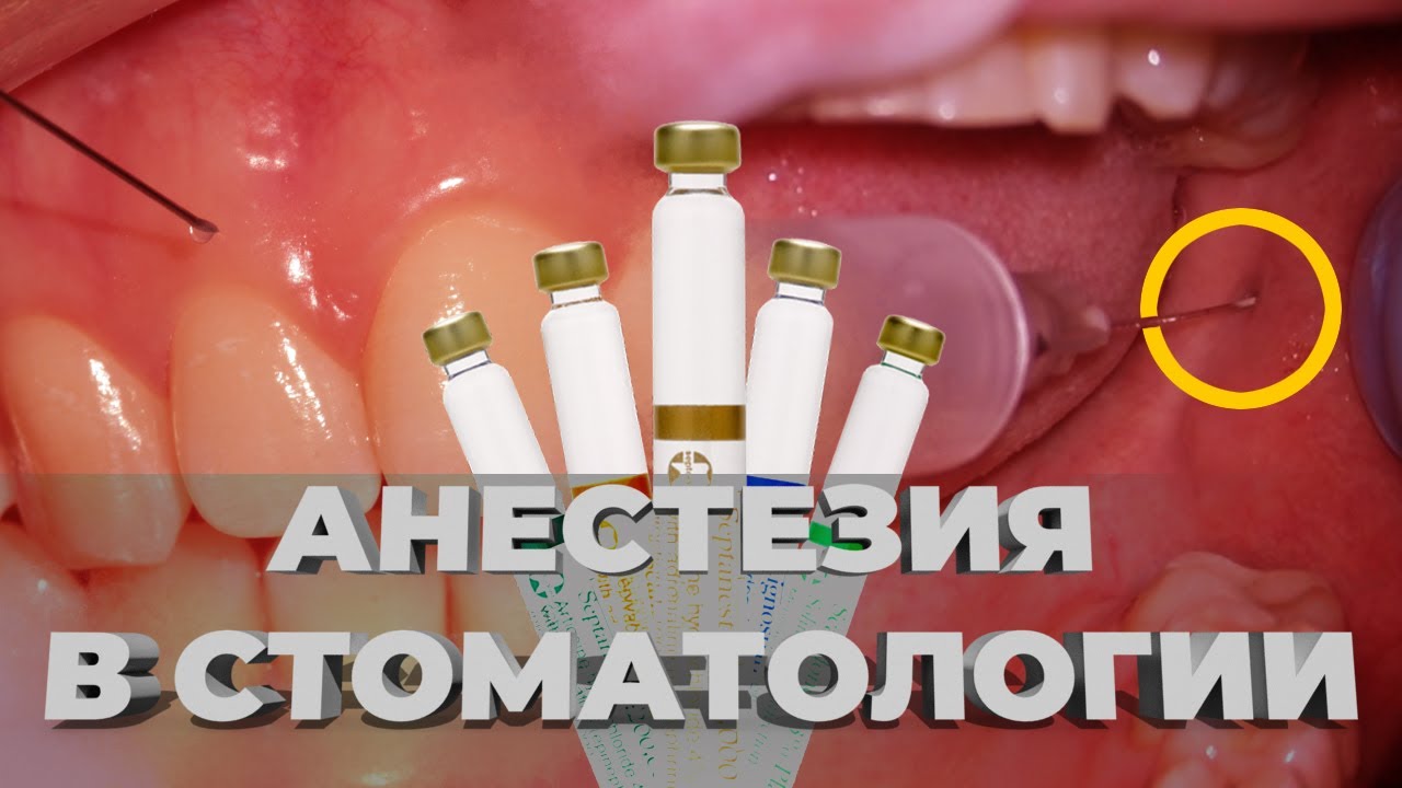АНЕСТЕЗИЯ В СТОМАТОЛОГИИ ЖИВАЯ ДЕМОНСТРАЦИЯ ИНФИЛЬТРАЦИОННАЯ ...