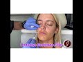 Botox and Undereye Filler