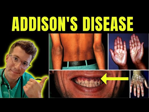 Videó: Addison betegsége befolyásolhatja a kutyákat