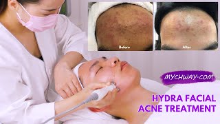 Hydrafacial Glowing Skin Before And After | Hydra facial Full Operation Tutorial | AF1318 Part II