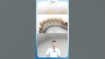 Điều Gì Khiến Niềng Răng Mắc Cài Mặt Lưỡi "Đắt Giá" Hơn | Bác Sĩ Yên