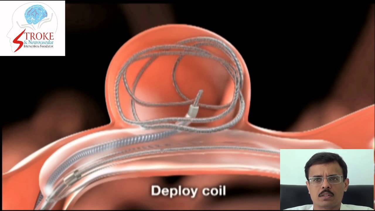 Balloon Assisted Coiling of Brain Aneurysm YouTube