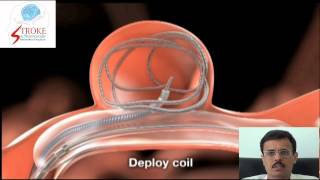 Balloon Assisted Coiling of Brain Aneurysm