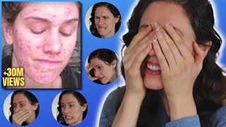 Esthetician Reacts To Horrific Cystic Acne Video That Went Viral 10 Years Ago Today...