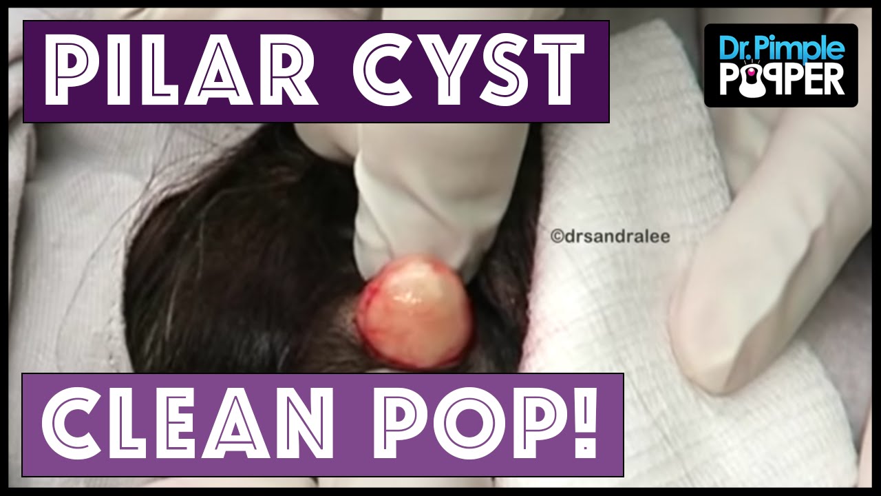 A Clean Pilar Cyst Pop Youtube