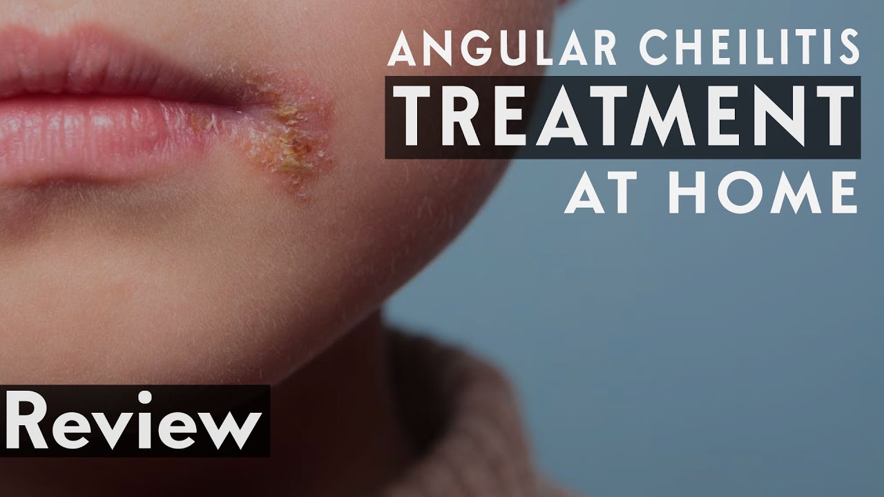Angular Cheilitis Treatment At Home Angular Cheilitis Treatment