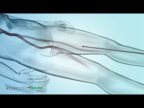 RelayPro Bare Stent   Deployment Animation    Terumo Aortic