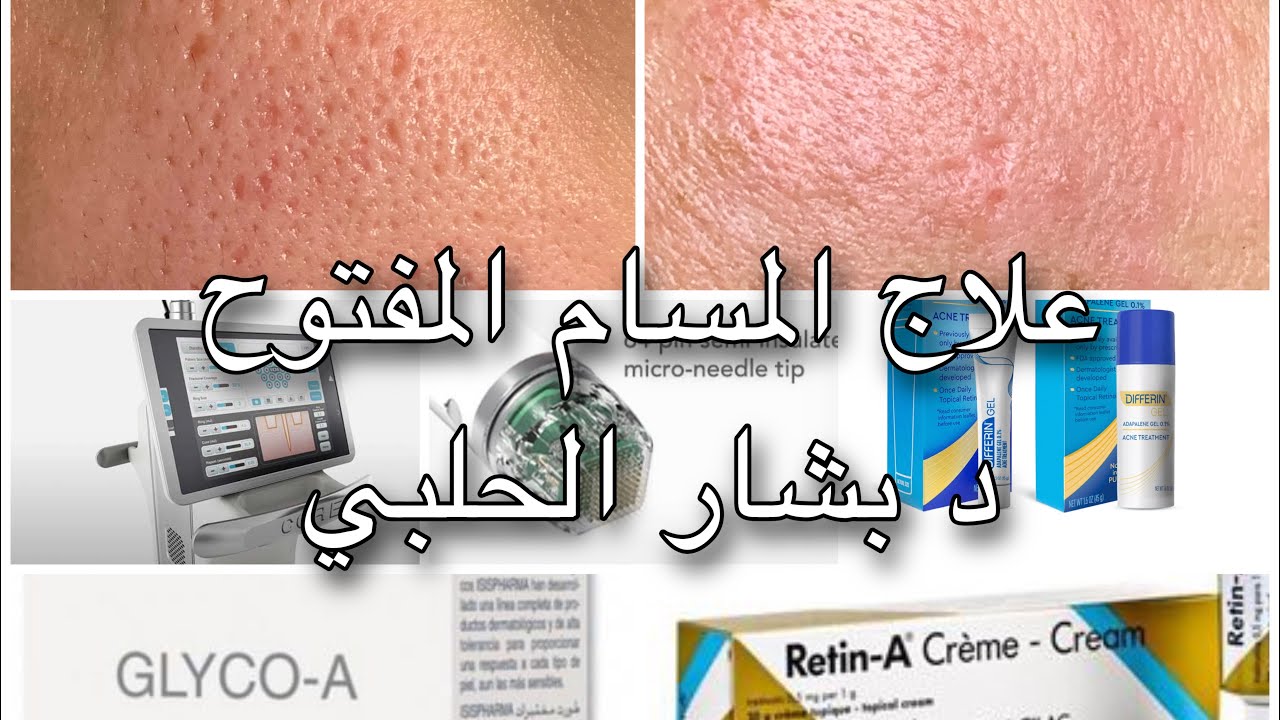 العلاجات الحقيقة للمسامات  المتوسعة Enlarged Pores ـ طبيب جلد و تجميل
