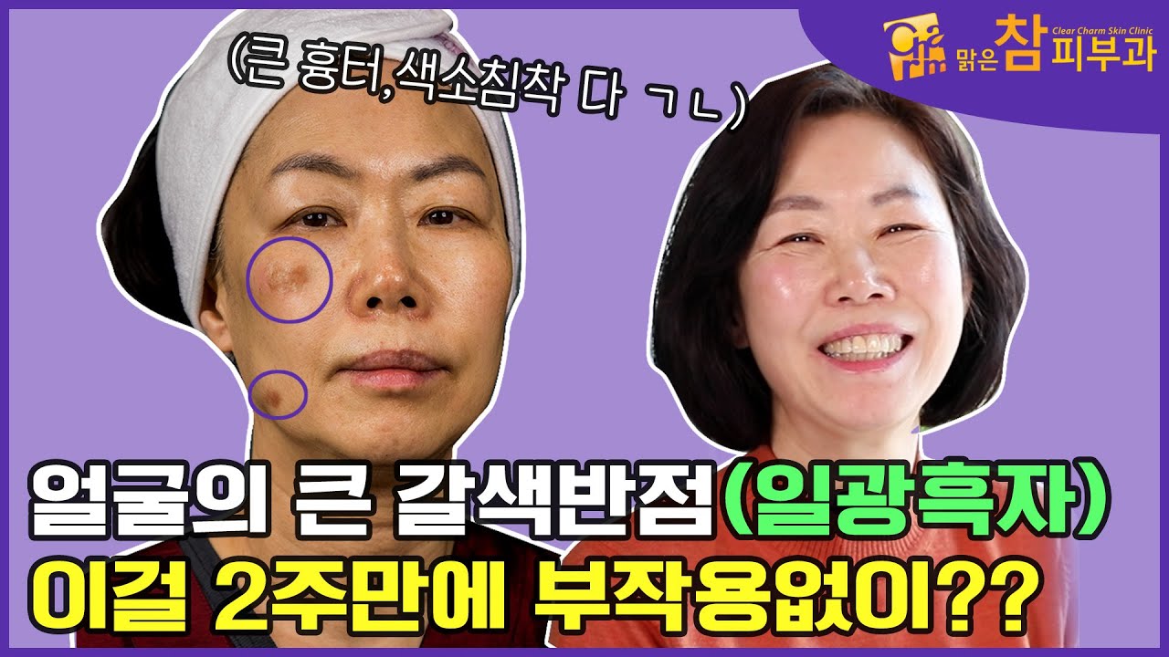 이게 가능하다고? 얼굴에 있는 큰 검버섯(흑자) 완전 제거! - YouTube