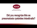 Diagnosing pneumatosis cystoides intestinalis with douglas rex md masge