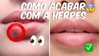 Curar e Previnir Herpes Labial | Cure em 48hs