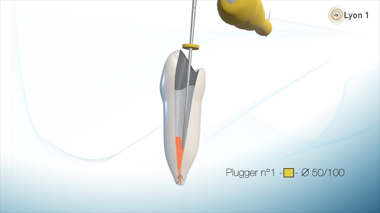 Obturation canalaire : technique de compactage vertical à chaud