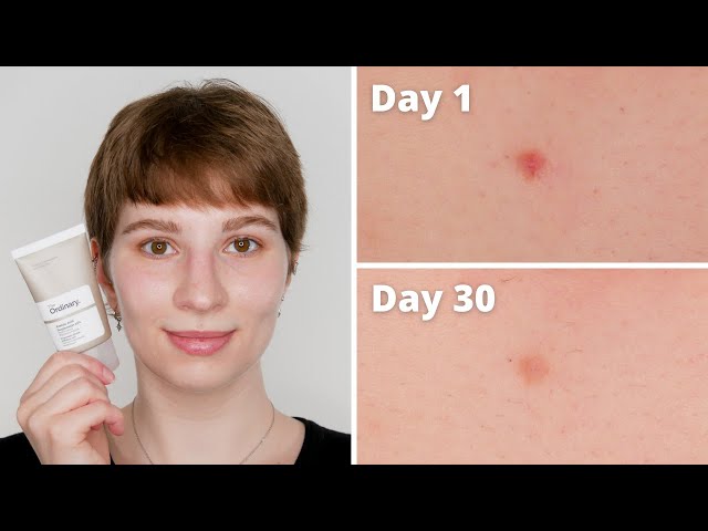 Azelaic Acid Before And After Azelaic Acid Anti Acne Gel Melasma
