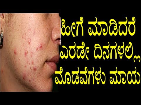Kannada tips on how to remove pimples fast ಹೀಗೆ ಮಾಡಿದರೆಎರಡೇ ದಿನಗಳಲ್ಲಿ ಮೊಡವೆಗಳು ಮಾಯ ! subscribe our channel https://goo.gl/tulnb1 facebook page :- htt...