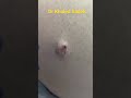 Massive blackhead extraction dr khaled sadek blackheads shorts drkhaledsadek