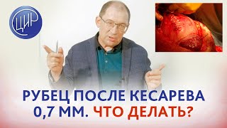 Рубец на матке после кесарева сечения 0,7 мм в 34 недели. Что делать? Может ли быть  разрыв рубца?