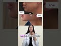 Deep plane facelift before &amp; after