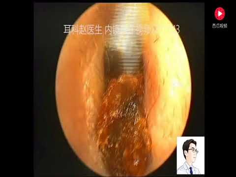 一例老年的双耳耵聍栓塞小花视频 Youtube