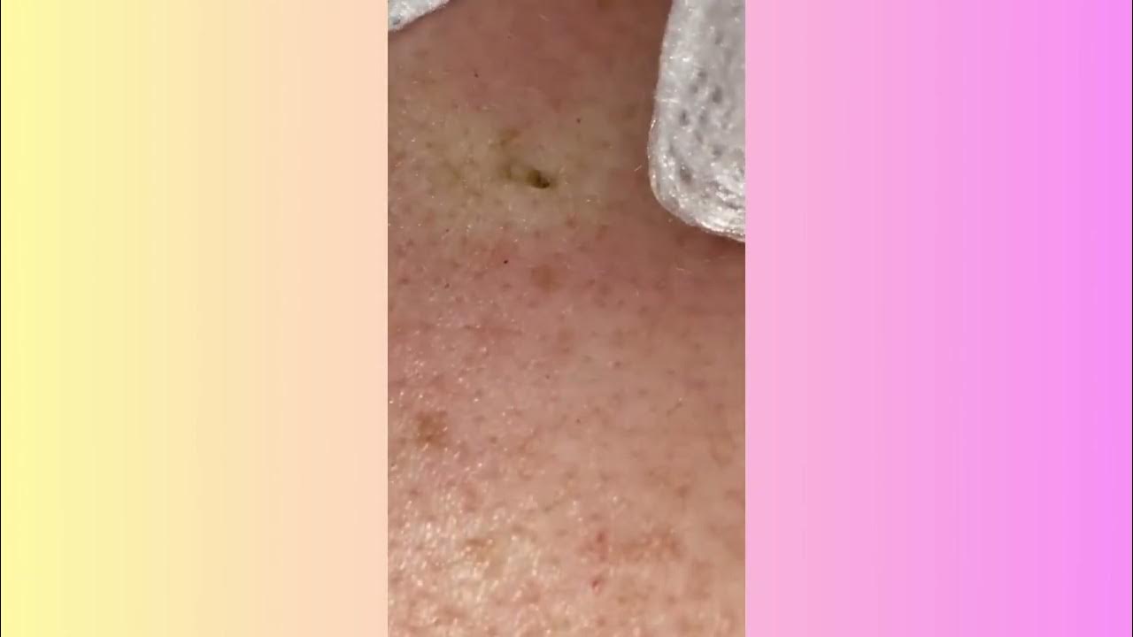 Popping huge blackheads and Pimple Popping Best Pimple Popping Videos