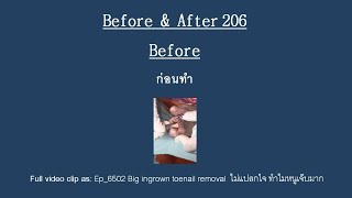BA_206 Before and After 👣 มาดูแผลเล็บขบหลังจากน้องมาทำกับพี่เอื้อม 😷 (Ep_6502)